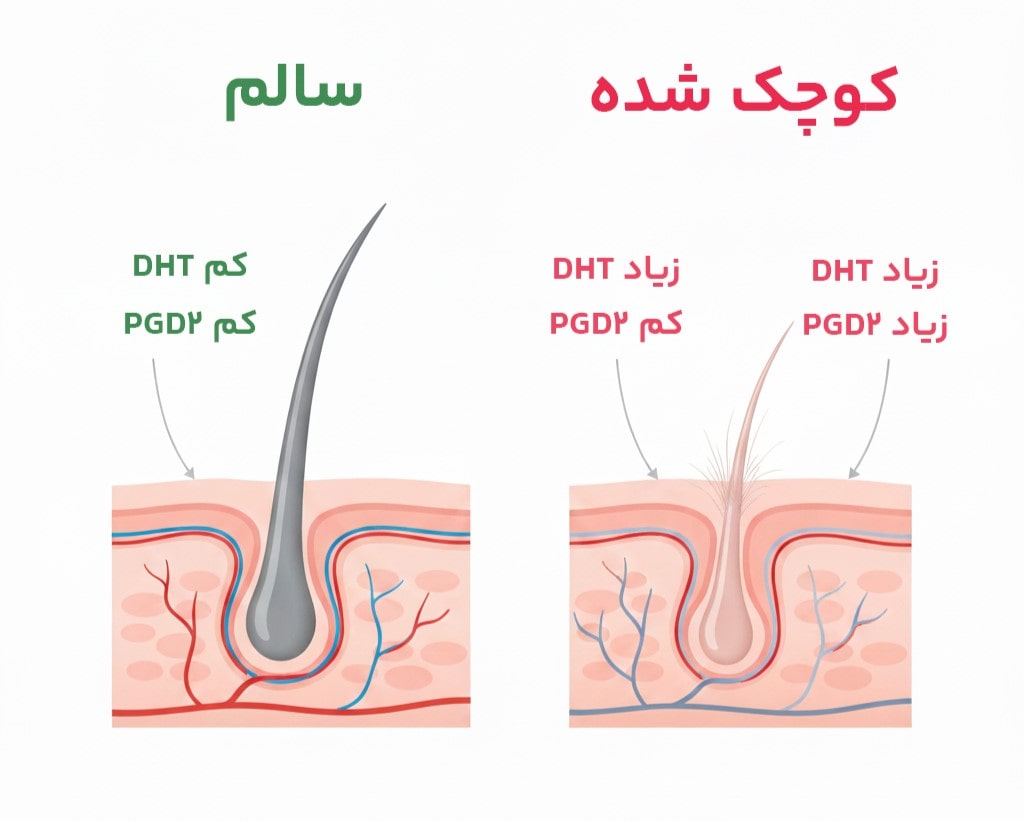تاثیر هورمون DHT و PGD2 بر ریزش مو و آلوپسی آندروژنیک