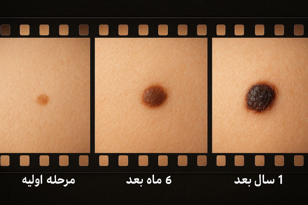 مراحل تغییر ظاهری و رشد یک خال خطرناک در طول زمان